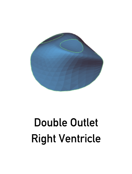 Double Outlet Right Ventricle