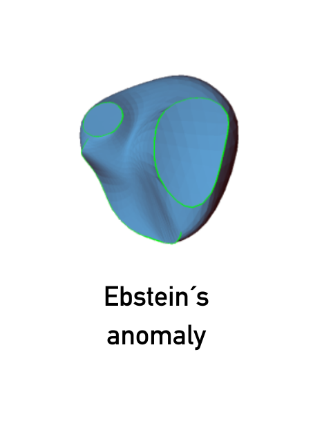 Ebstein´s anomaly