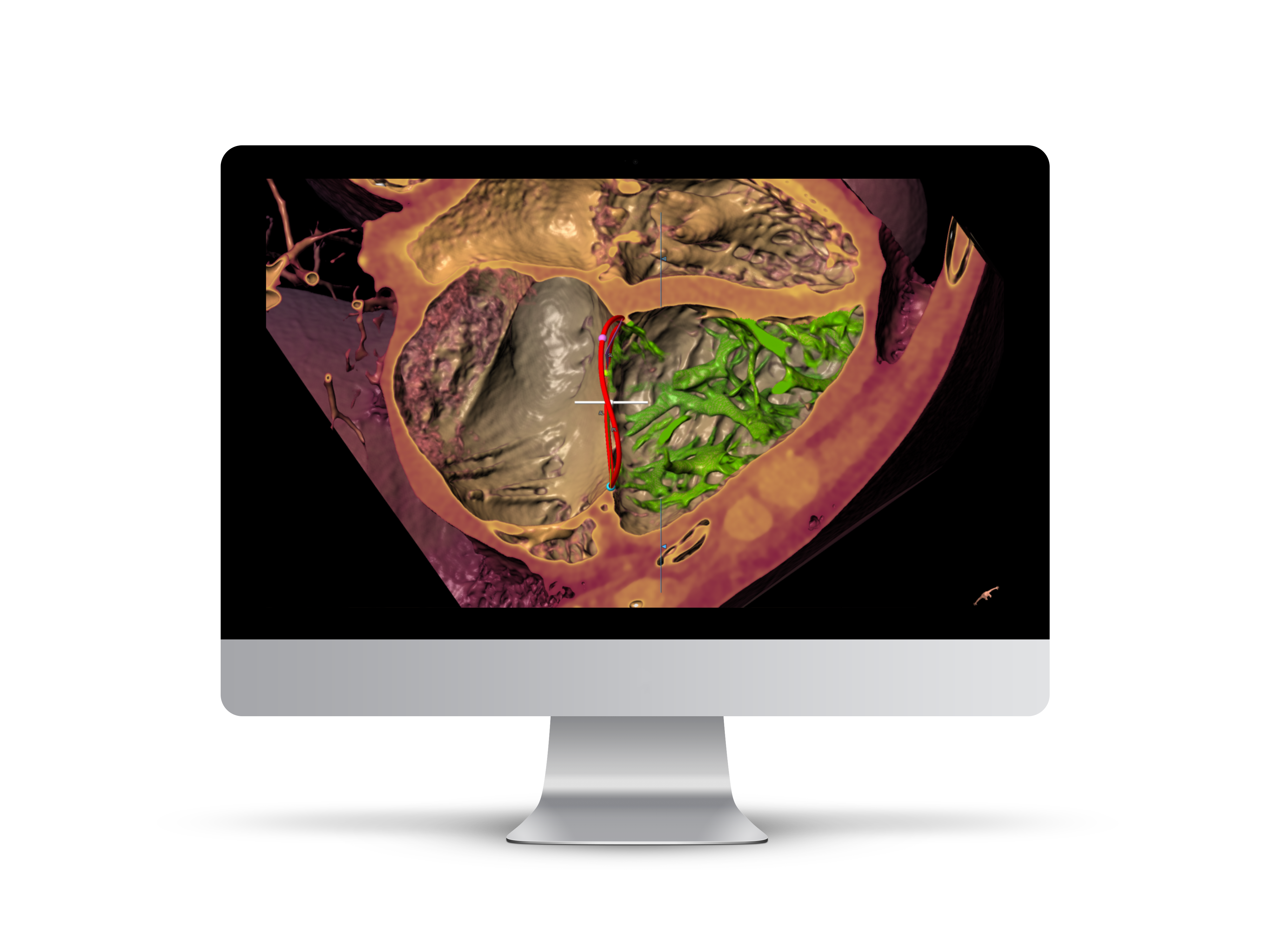 iMac_Tricuspid